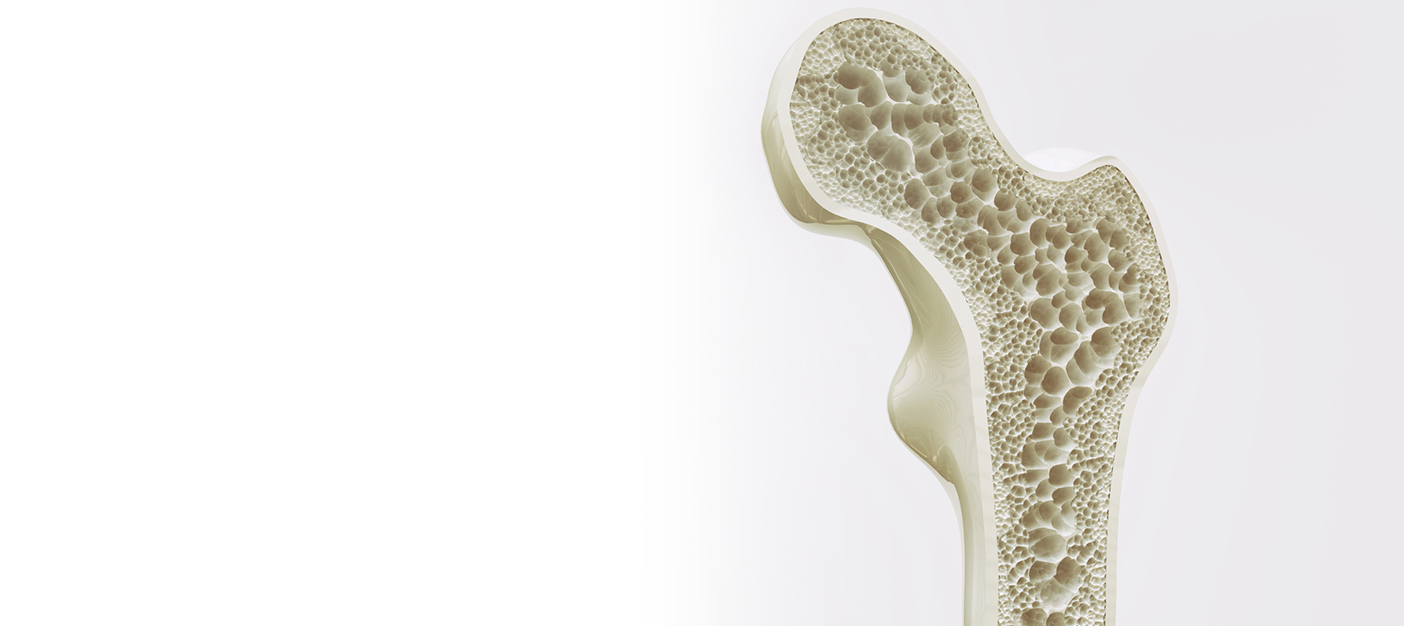 Protecting Fragile Bones: Key Strategies for Lifelong Strength and Mobility